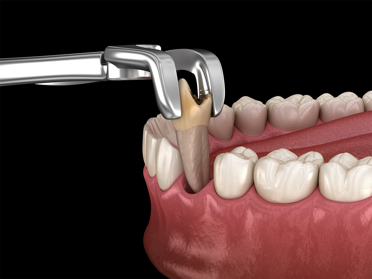 Tooth Extraction