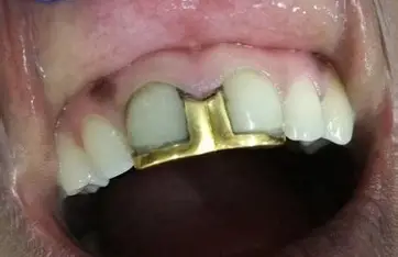Gold & Silver removal + filling