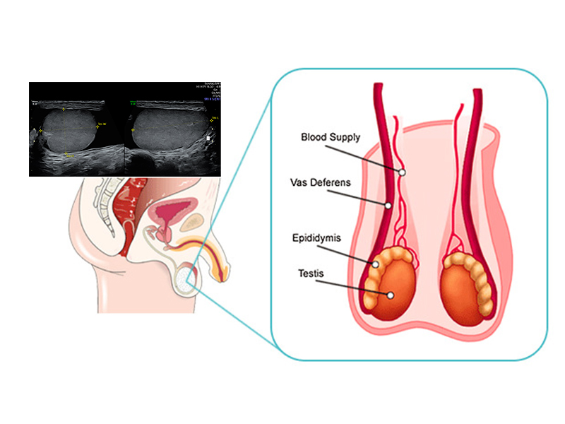 Testicular Ultrasound